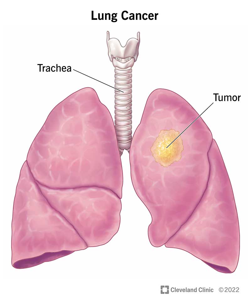 Read more about the article A new peptide for the treatment of non-small cell lung cancer